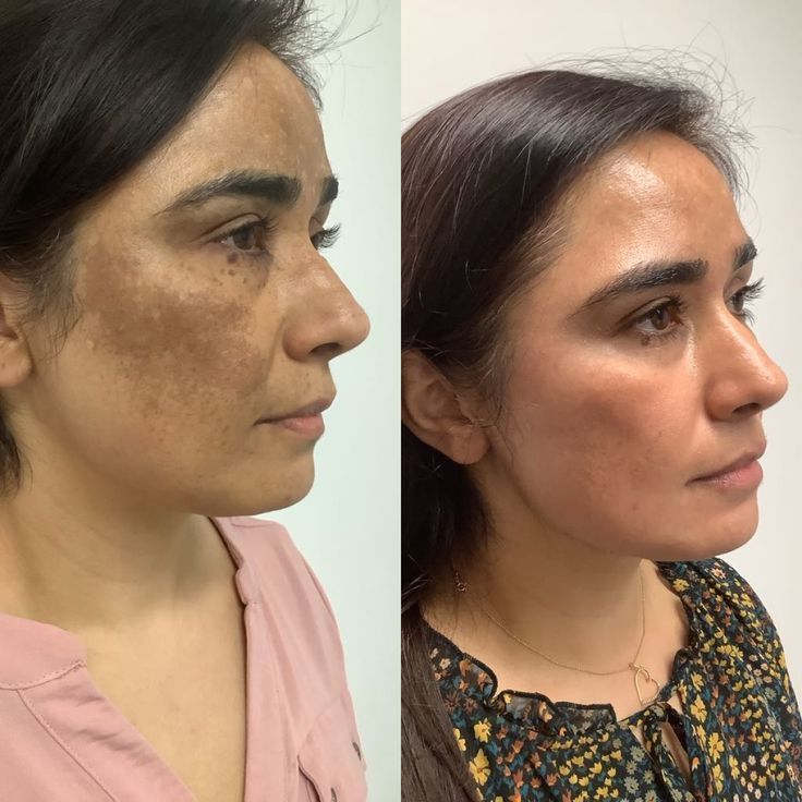 Lifting facial antes vs después